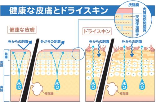 角質